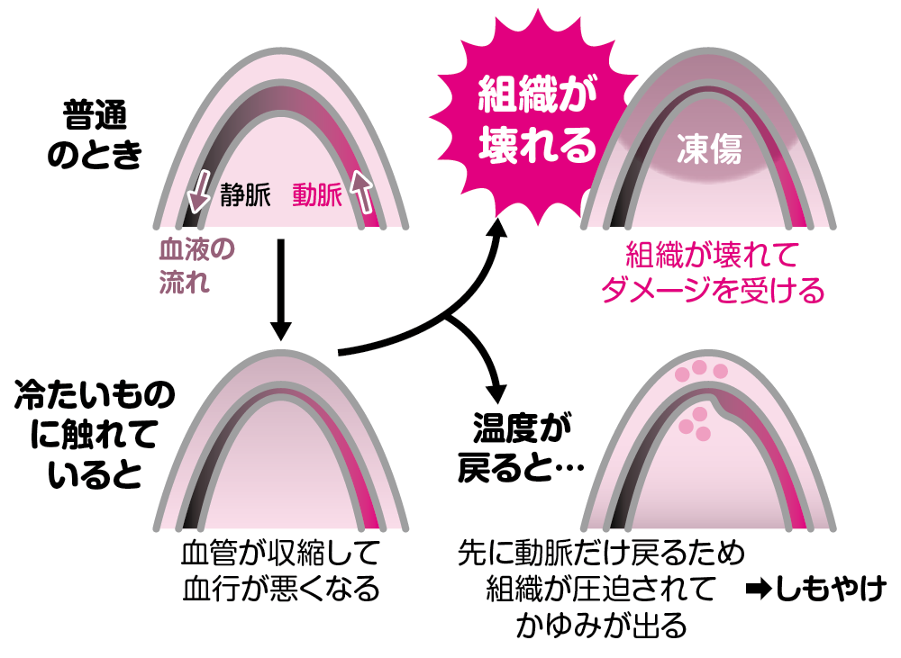 コレクション 火傷 服の上から冷やす 理由